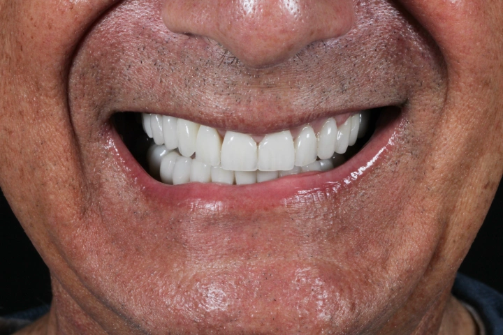 Close-up of a smiling middle-aged person showing clean, white teeth.