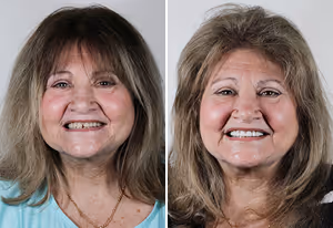 Before and after photos of a middle-aged woman showing a brighter, fuller smile in the after image.