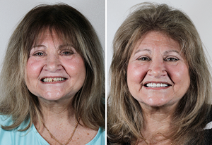 Before and after photos of a middle-aged woman showing a brighter, fuller smile in the after image.