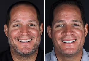 Side-by-side portrait of a man smiling before and after dental treatment, showing improved teeth and gums in the after photo.