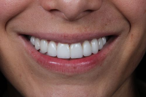 patient smiling after getting porcelain veneers in Kendall, FL