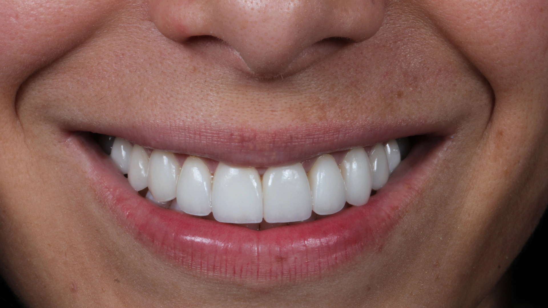 patient smiling after getting porcelain veneers in Kendall, FL