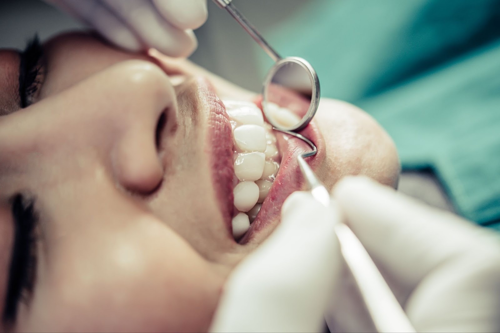 Dentist carefully applying composite bonding material to front teeth