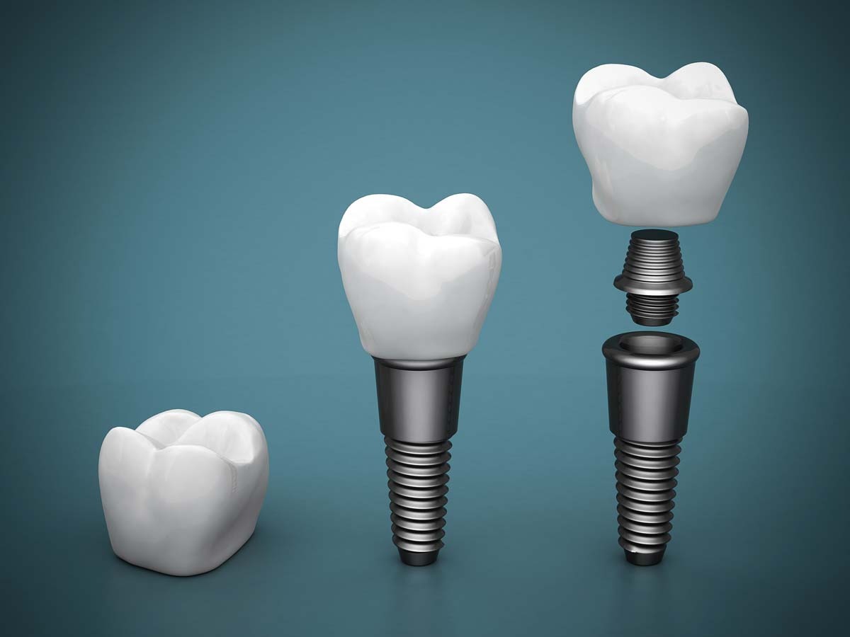Diagram showing dental implant components including titanium implant post abutment and crown used to replace a missing tooth