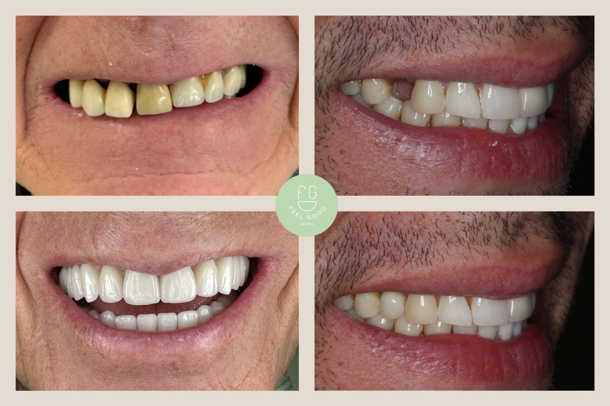 Before and after dental implants in Croydon by Dr Nev at Feel Good Dental showing restored smile and natural-looking teeth replacement