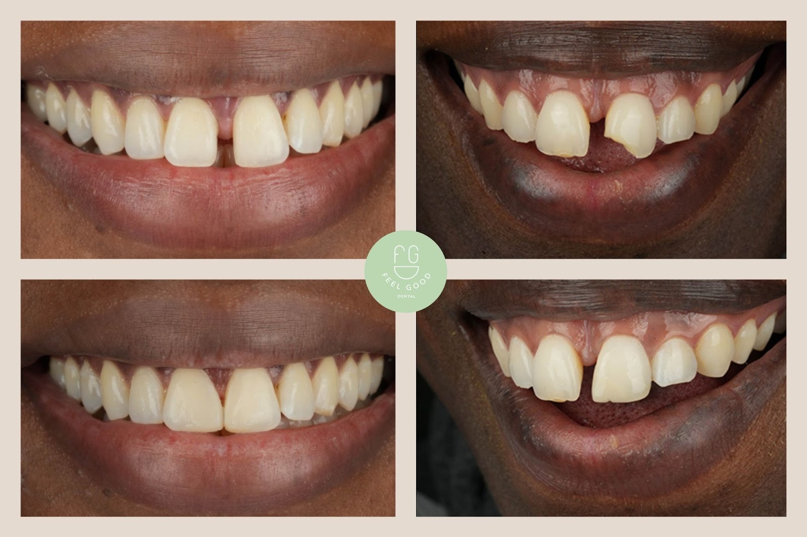 Composite bonding before and after results showing chipped and uneven front teeth improved with cosmetic dental treatment at Feel Good Dental in Corydon