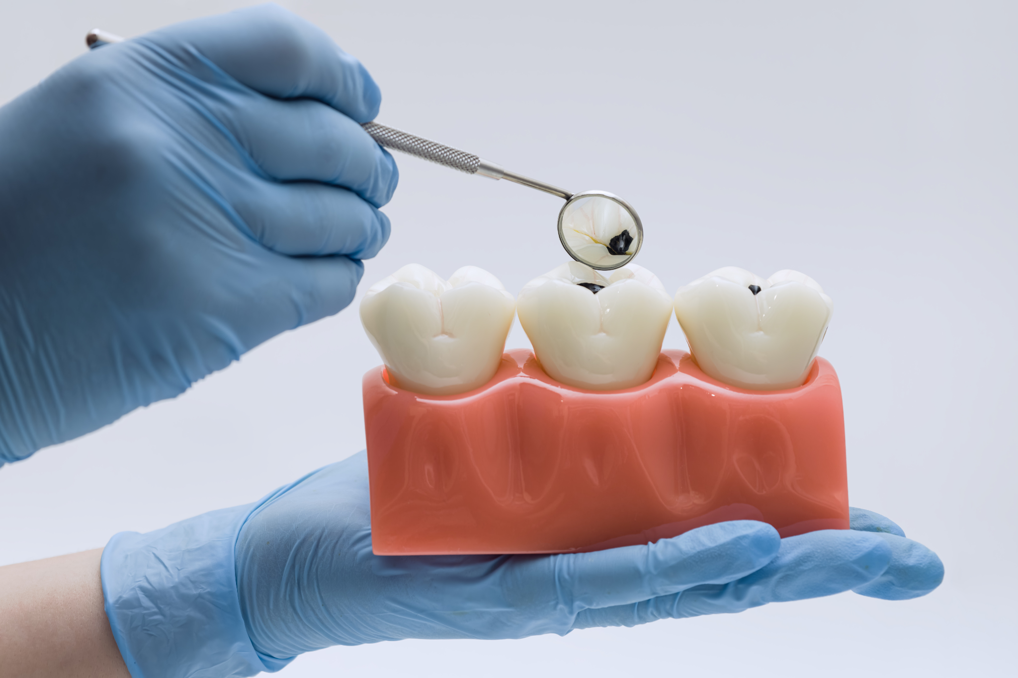 Dentist examining tooth decay using dental mirror before placing a filling