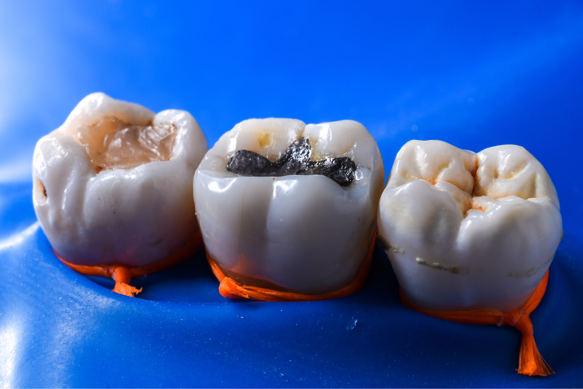 Composite and amalgam dental fillings compared with natural tooth decay in molars