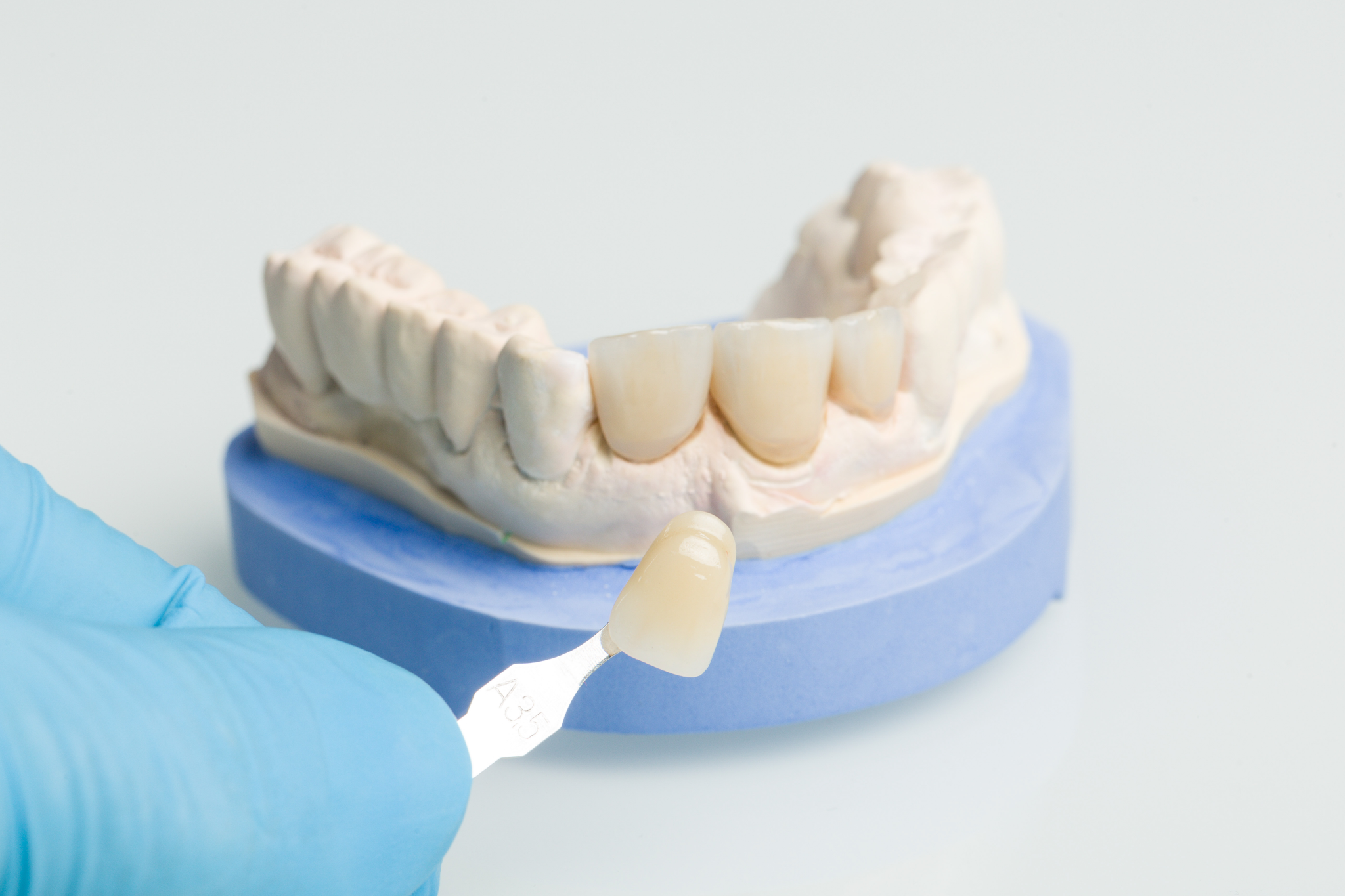 Porcelain veneers fitted to dental model during smile makeover treatment planning