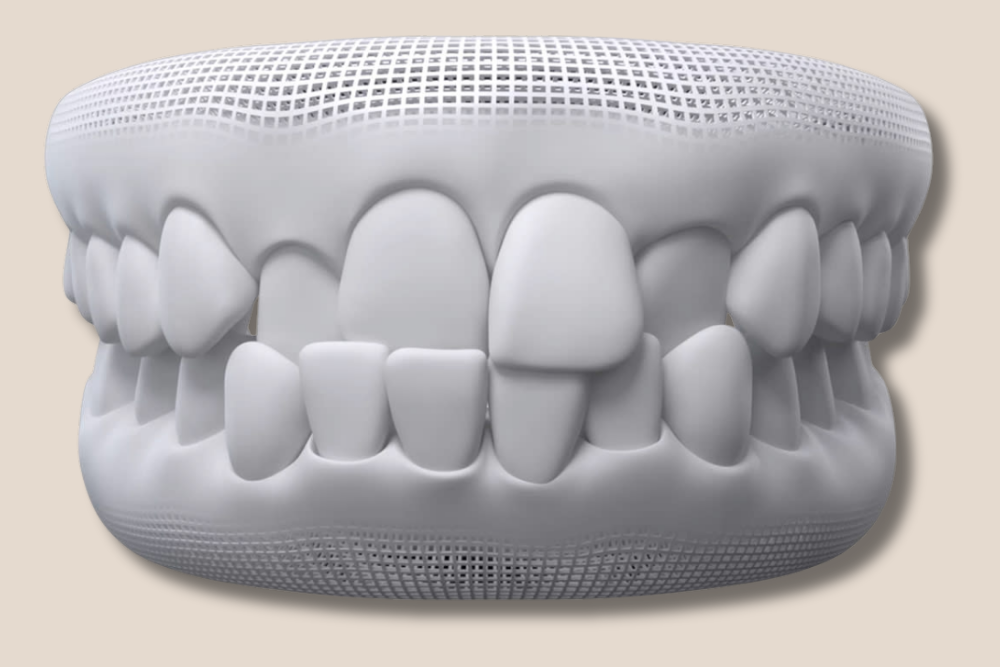 3D dental model showing crowded and misaligned teeth before Invisalign treatment