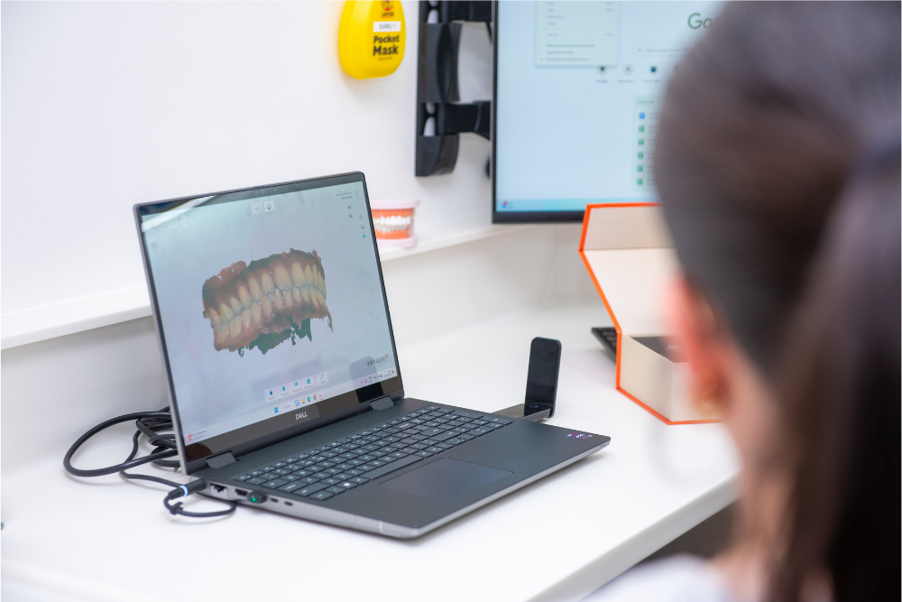 Digital 3D scan of teeth used to plan Invisalign treatment at Feel Good Dental Croydon