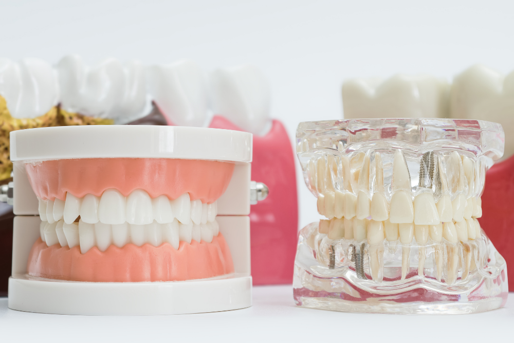 Dental models comparing removable dentures with implant supported replacement teeth