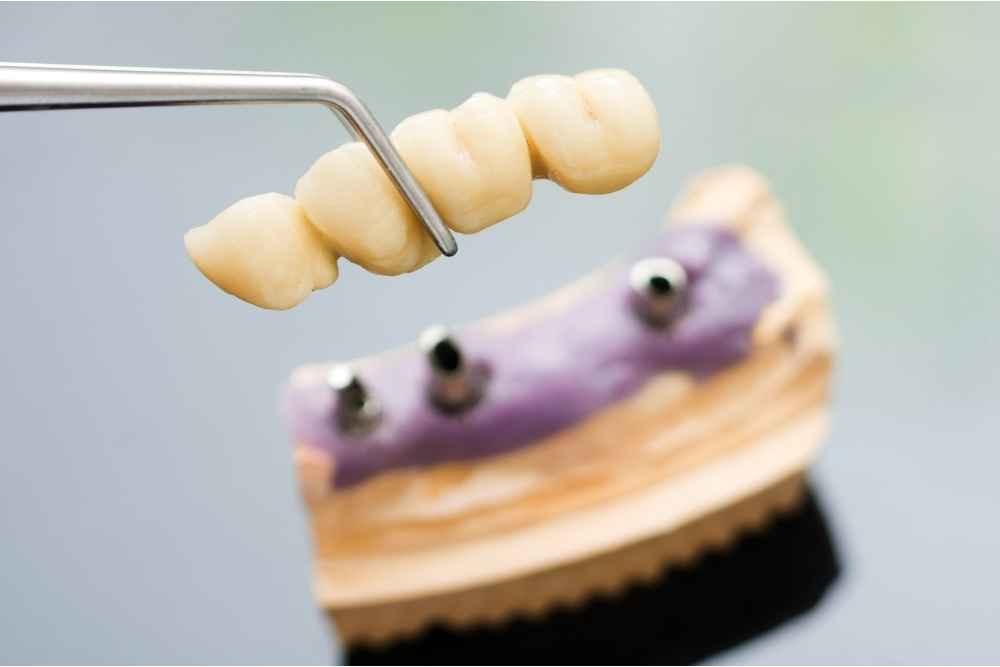 Implant-supported dental bridge and dental implant model