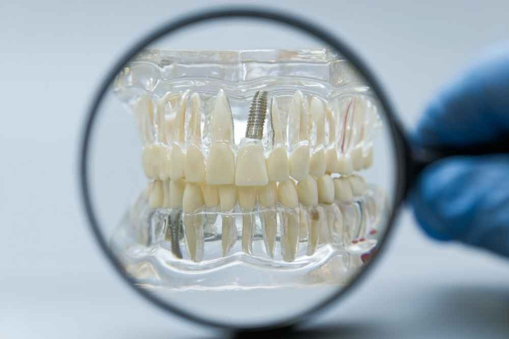 Dental model showing implants used to replace missing teeth
