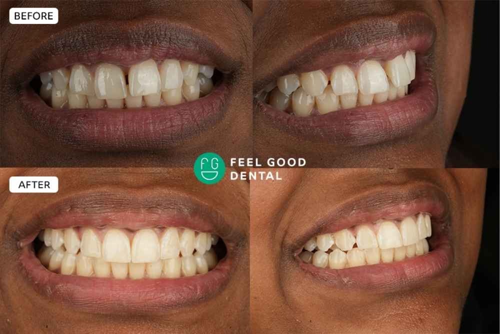Before and after Invisalign results from a Feel Good Dental patient in Croydon