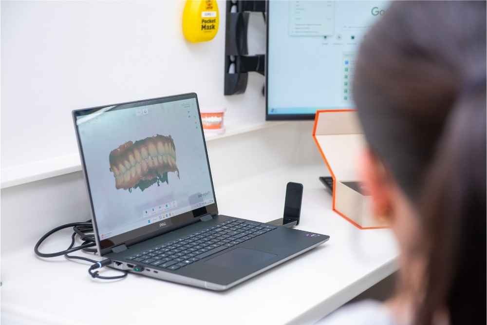 Digital Invisalign treatment planning showing teeth on a computer screen