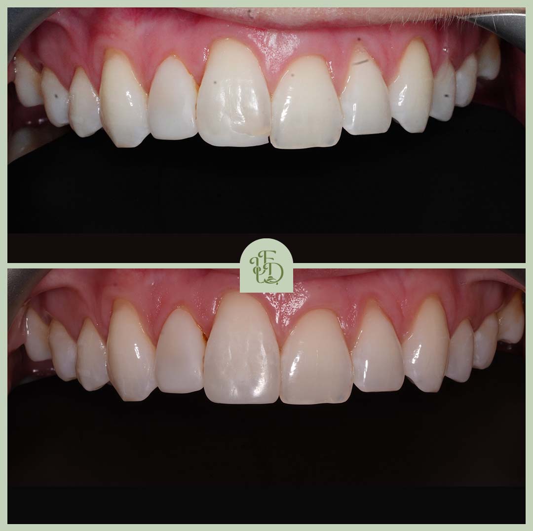 Edge bonding before and after. Subtle enhancements to the front teeth edges for a balanced and natural smile.