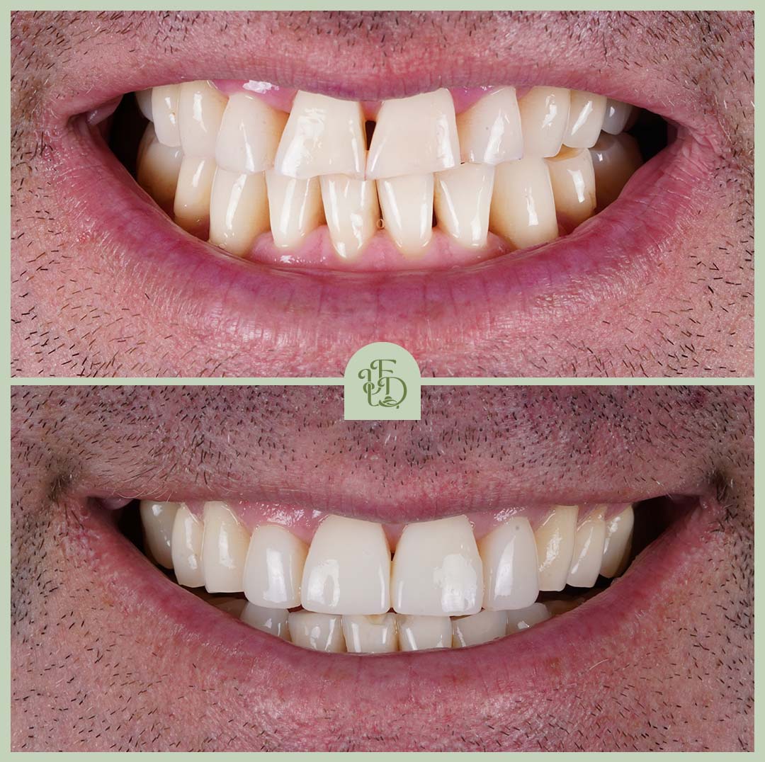 Before and after composite bonding. Gaps and uneven edges in the front teeth corrected to create a confident, natural smile.