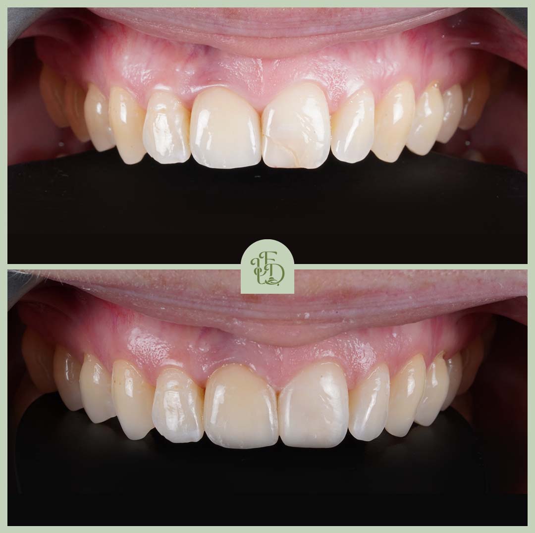 Composite bonding results at Foxley Lane Dental in Purley. Cracks and uneven edges on front teeth restored for a smooth, natural smile.