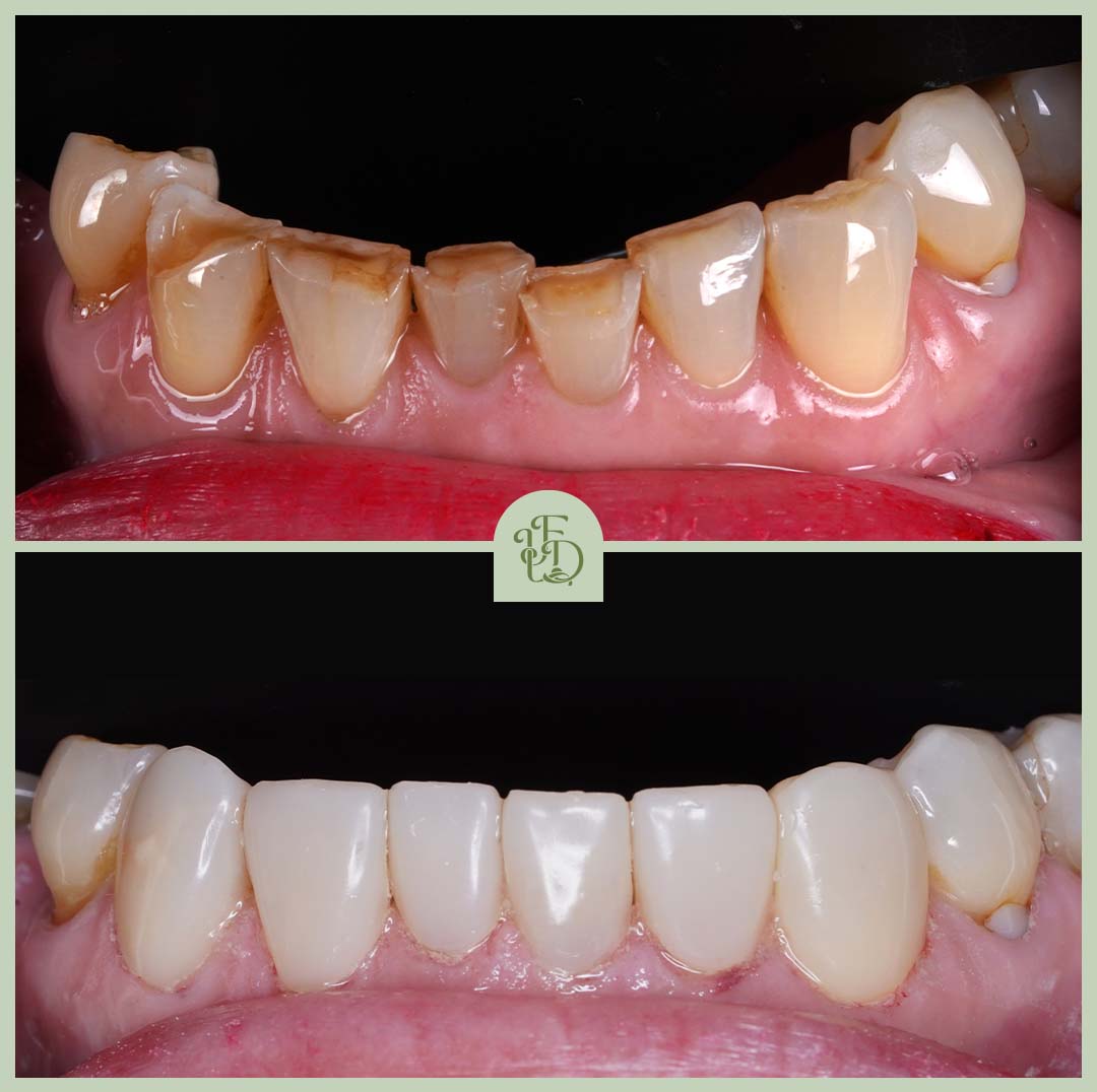 Before and after composite bonding on lower teeth at Foxley Lane Dental in Purley, near Croydon. Worn and uneven teeth restored for a healthier, natural smile.