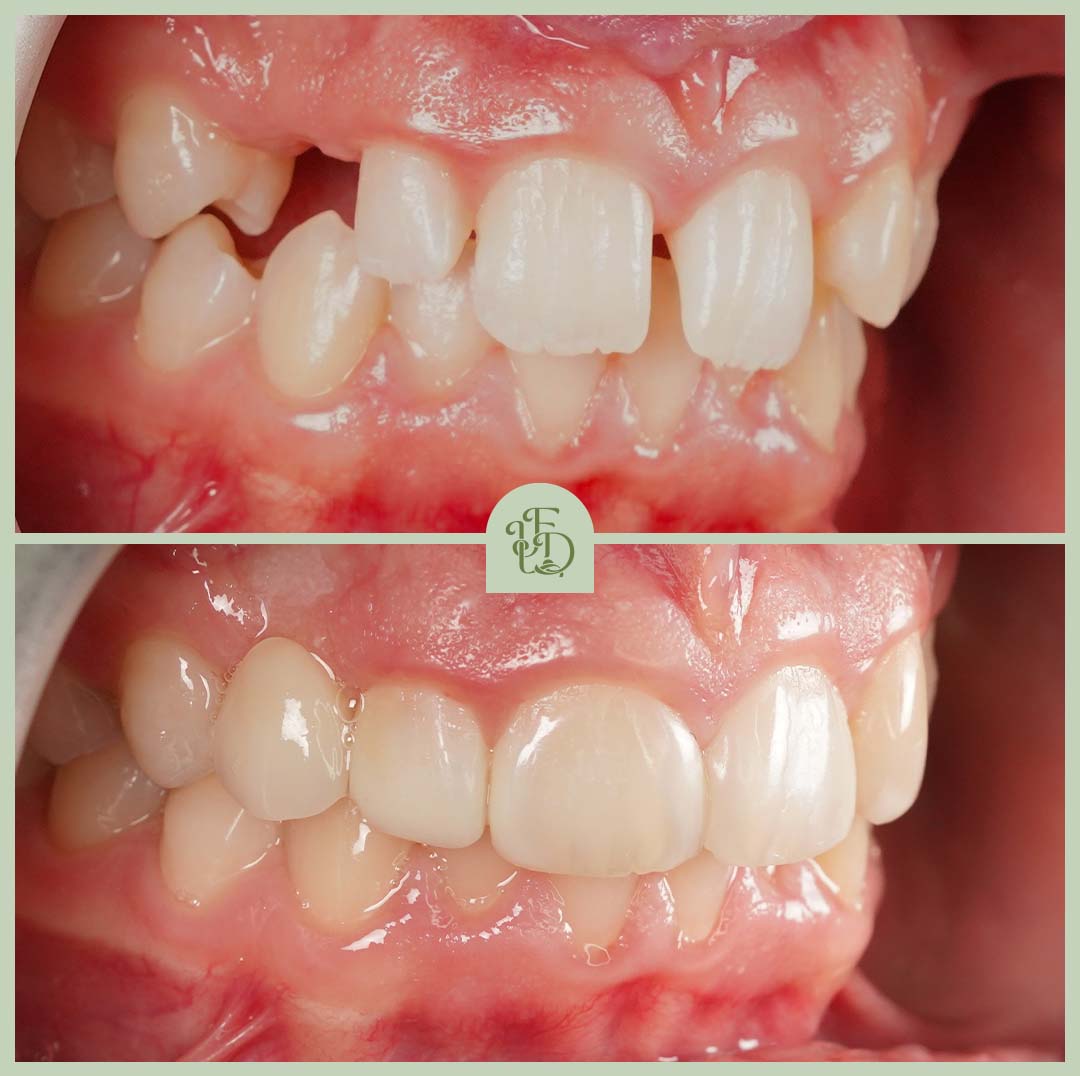 Composite bonding before and after near Selsdon. Treatment corrected uneven and gapped front teeth, creating a smooth, natural smile with expert cosmetic dentistry.