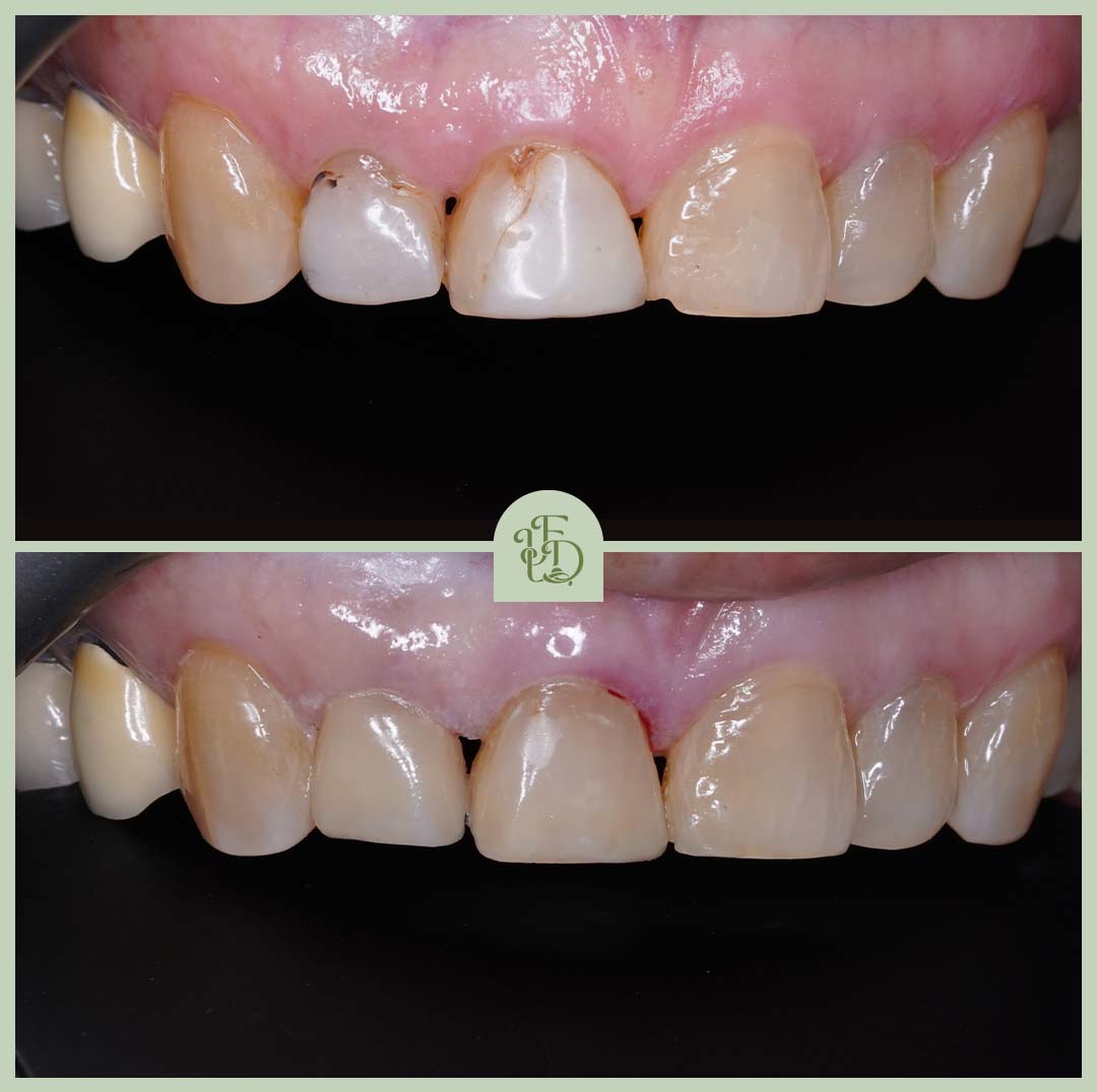 Before and after composite bonding treatment at Foxley Lane Dental near Coulsdon. Patient’s chipped and discoloured front teeth restored for a natural, even smile with expert cosmetic dentistry.