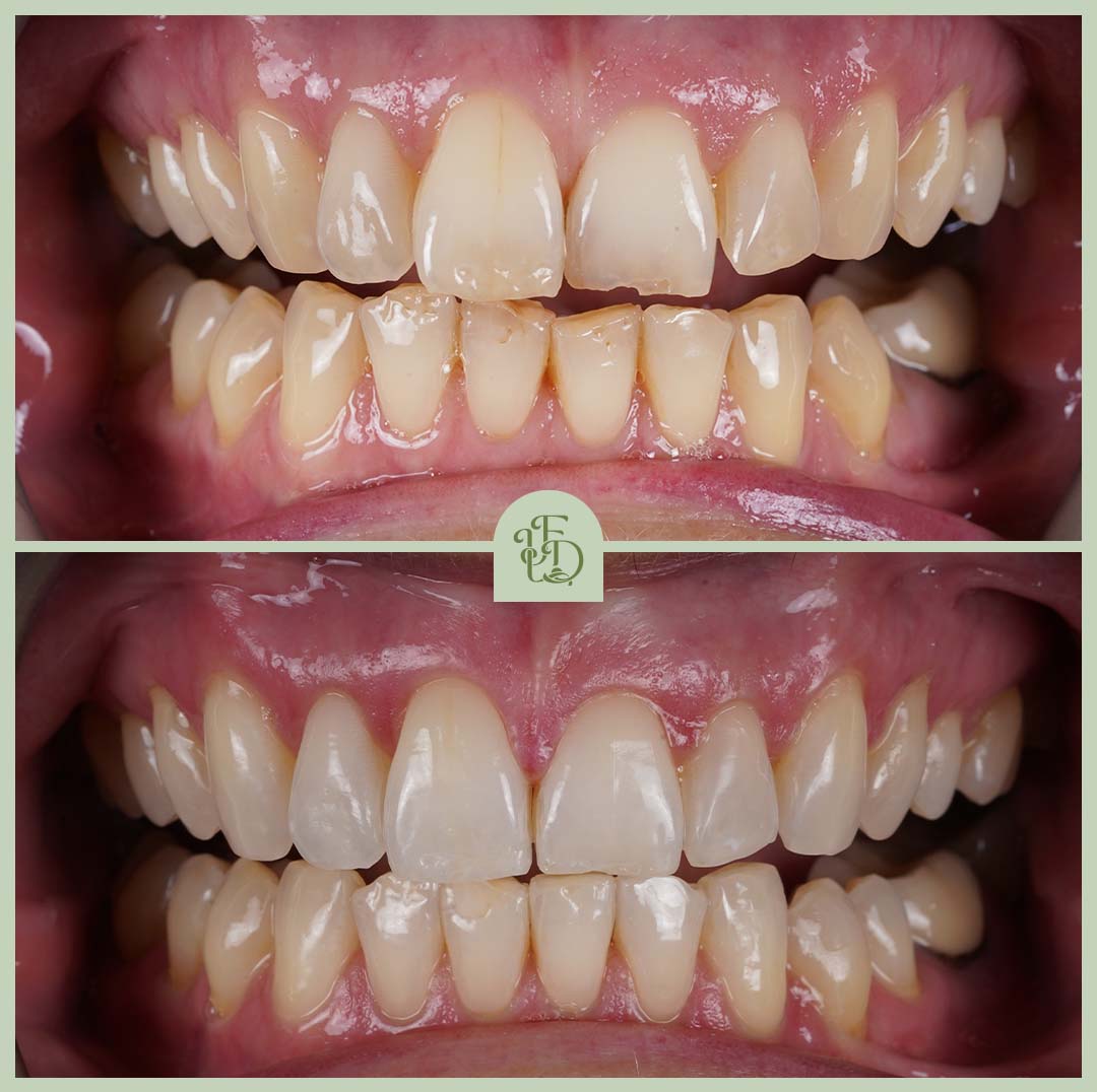 Invisalign results at Foxley Lane Dental near Croydon, improving tooth alignment and creating a straighter, healthier smile.