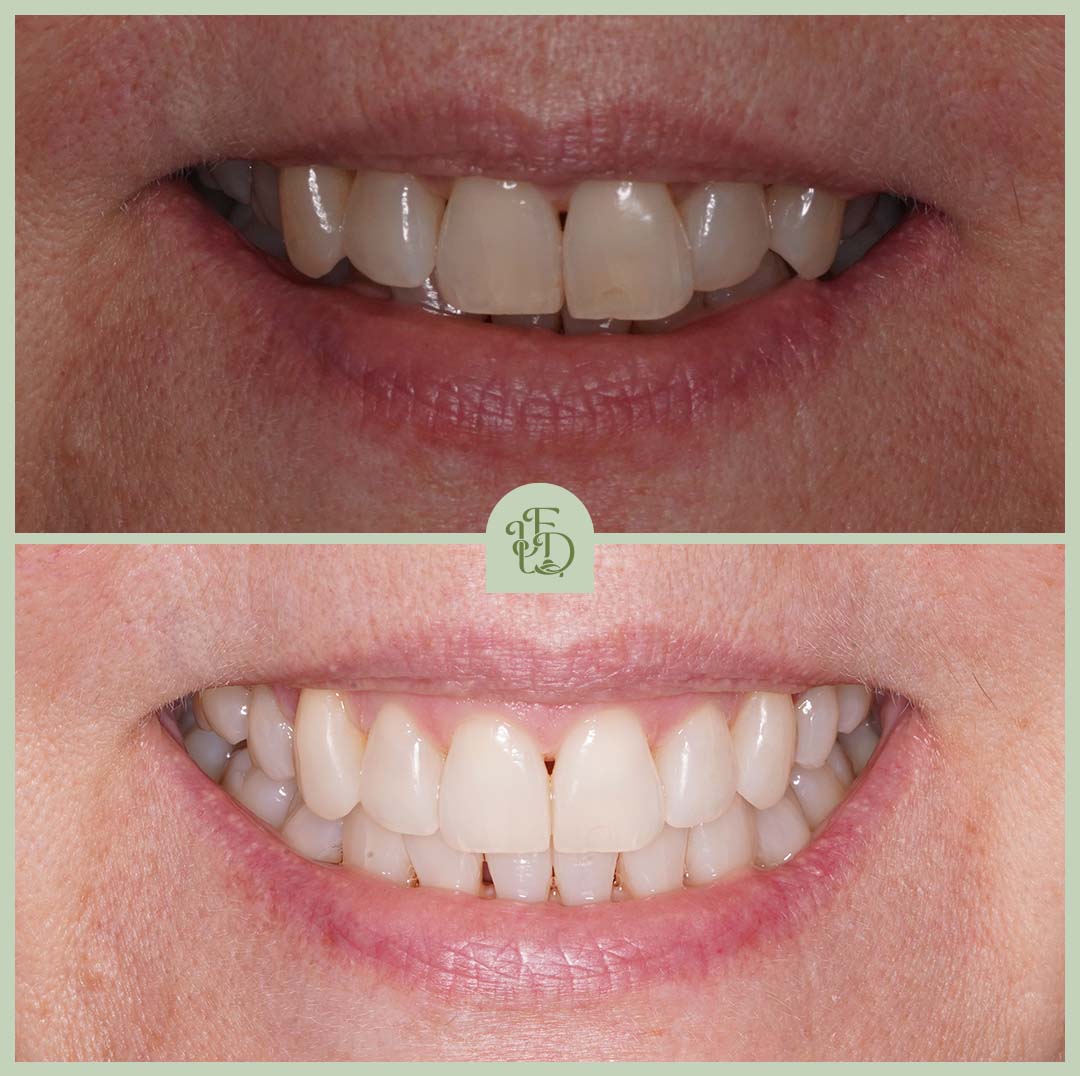 Invisalign before and after at Foxley Lane Dental in Purley, closing gaps and straightening teeth for a confident smile.