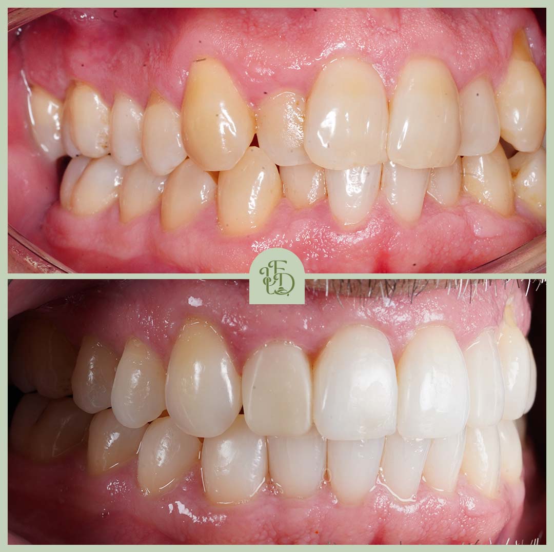 Before and after Invisalign treatment correcting crowded teeth and improving the bite for a straighter, healthier smile.