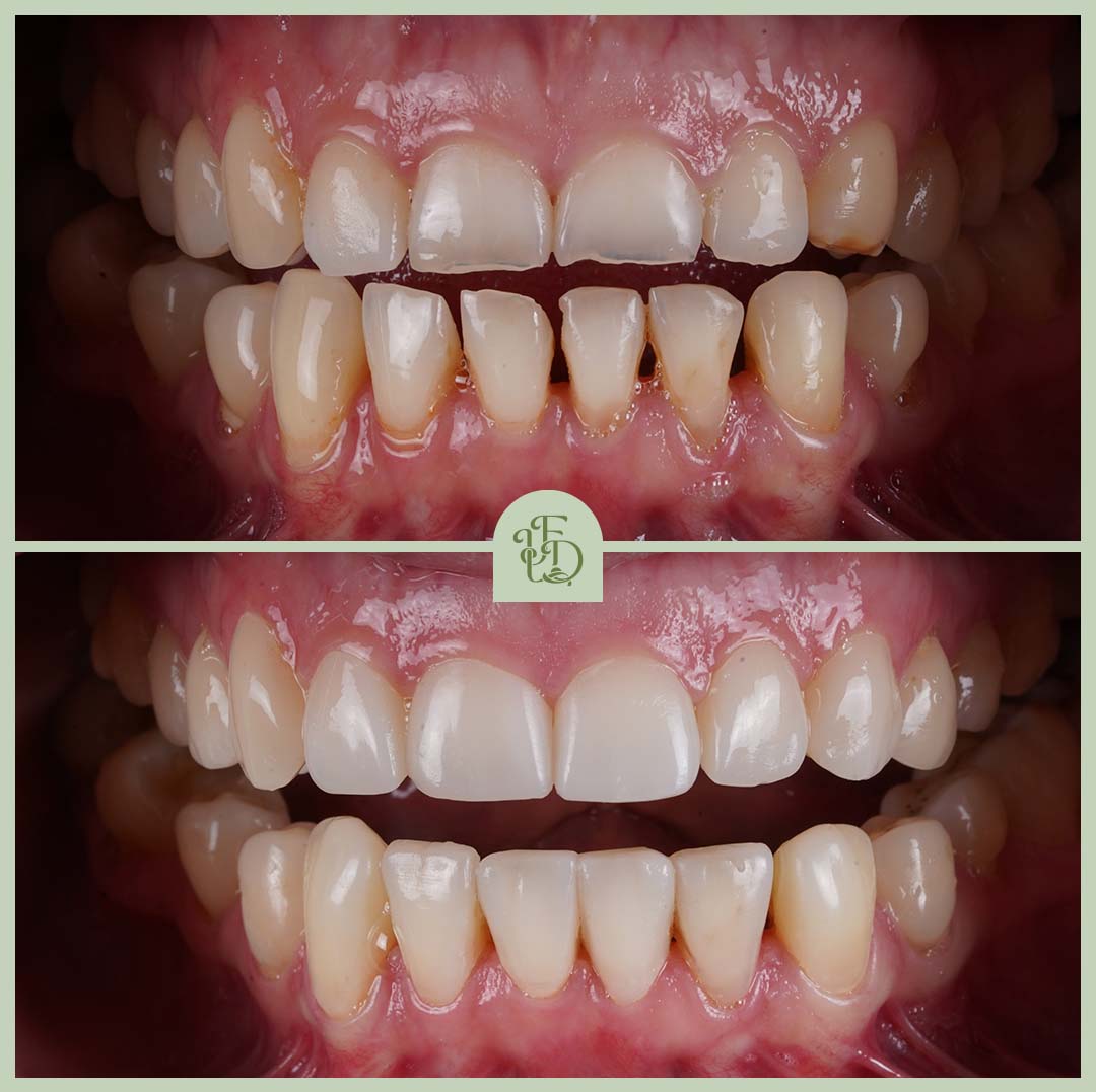 Before and after Invisalign treatment showing straighter, more even teeth with improved bite alignment.