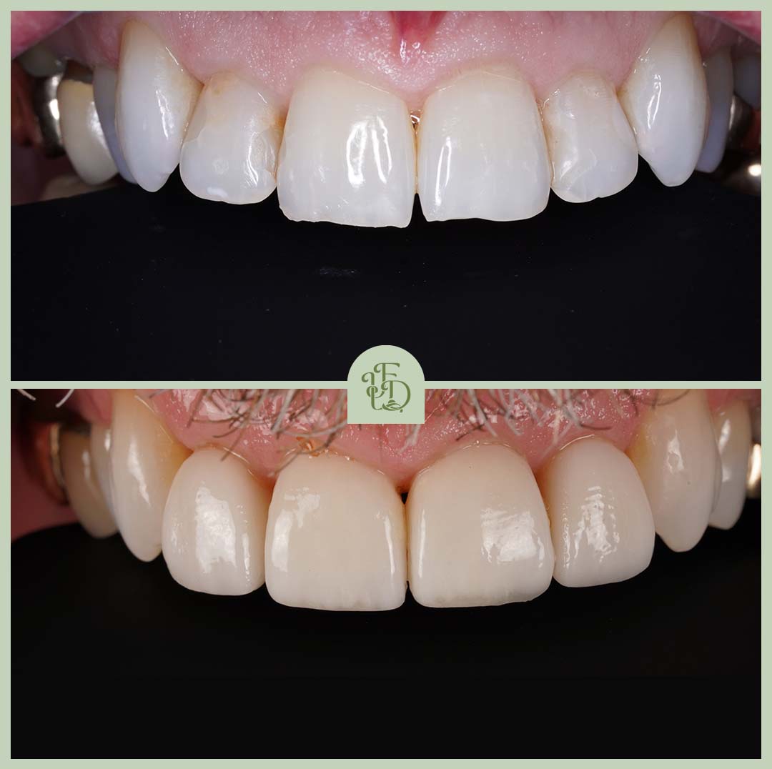 Porcelain veneers at Foxley Lane Dental in Purley, near Croydon. Front teeth restored for a whiter, more even smile.