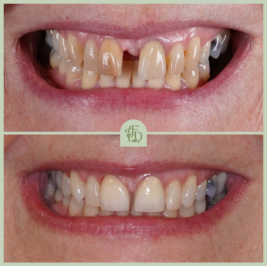 Smile transformation with veneers at Foxley Lane Dental in Purley. Missing and discoloured teeth restored for a natural-looking result.