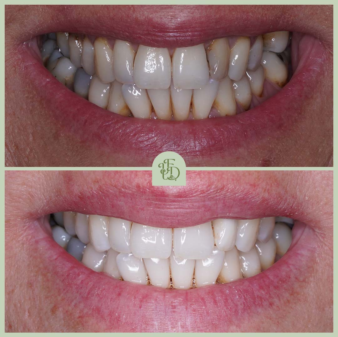 Teeth whitening results at Foxley Lane Dental in Purley, near Croydon. Professional treatment for a brighter, whiter smile.