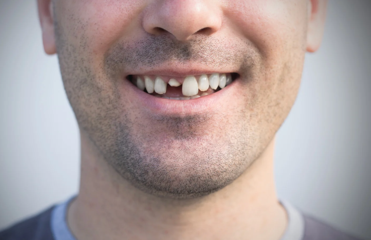 Close-up of man’s smile with missing front tooth after dental injury, awaiting emergency treatment in Croydon