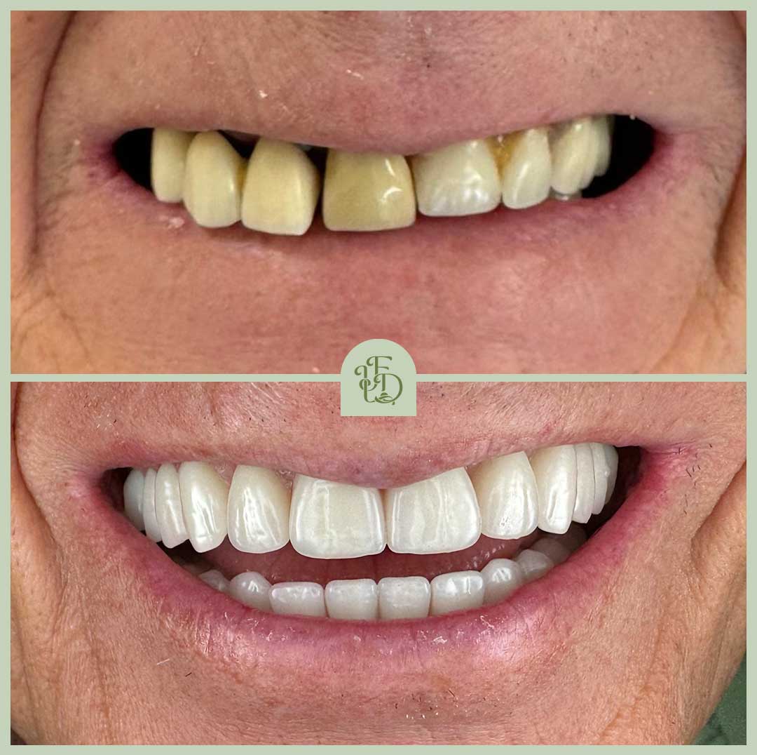 Before and after dental implant replacing a discoloured upper front tooth at Foxley Lane Dental in Purley, showing improved colour match and symmetry.