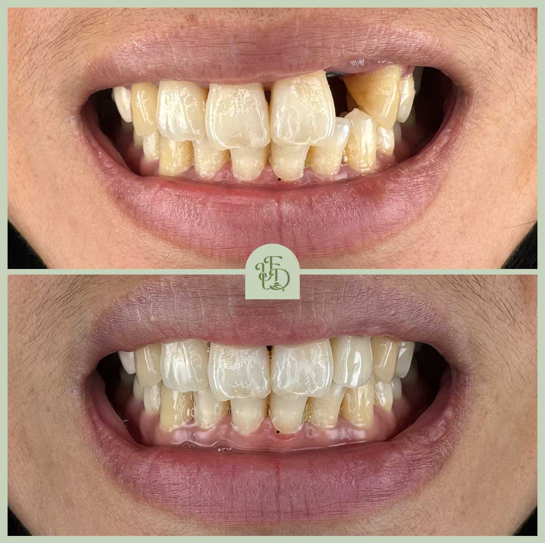 Before and after image of a single upper front dental implant in Purley, restoring a missing tooth with a natural-looking custom crown.