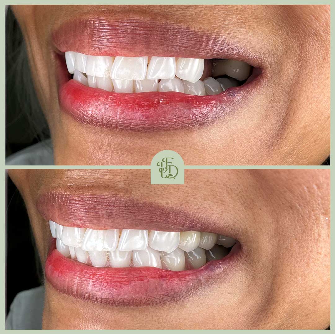 Before and after single tooth dental implant in Purley, with implant crown blended to match surrounding natural teeth.