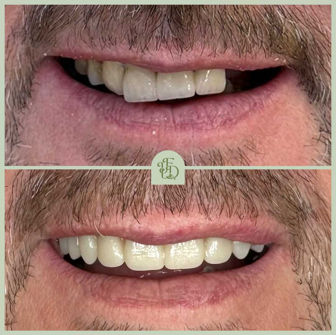 Before and after dental implants replacing damaged upper teeth, showing improved alignment and smile aesthetics at Foxley Lane Dental.
