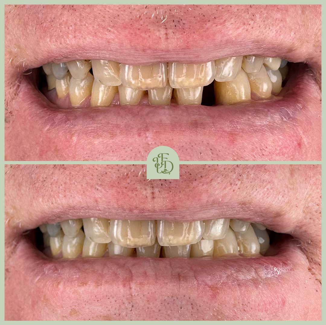 Before and after front tooth dental implant in Purley, restoring a missing tooth with a custom-made implant crown.