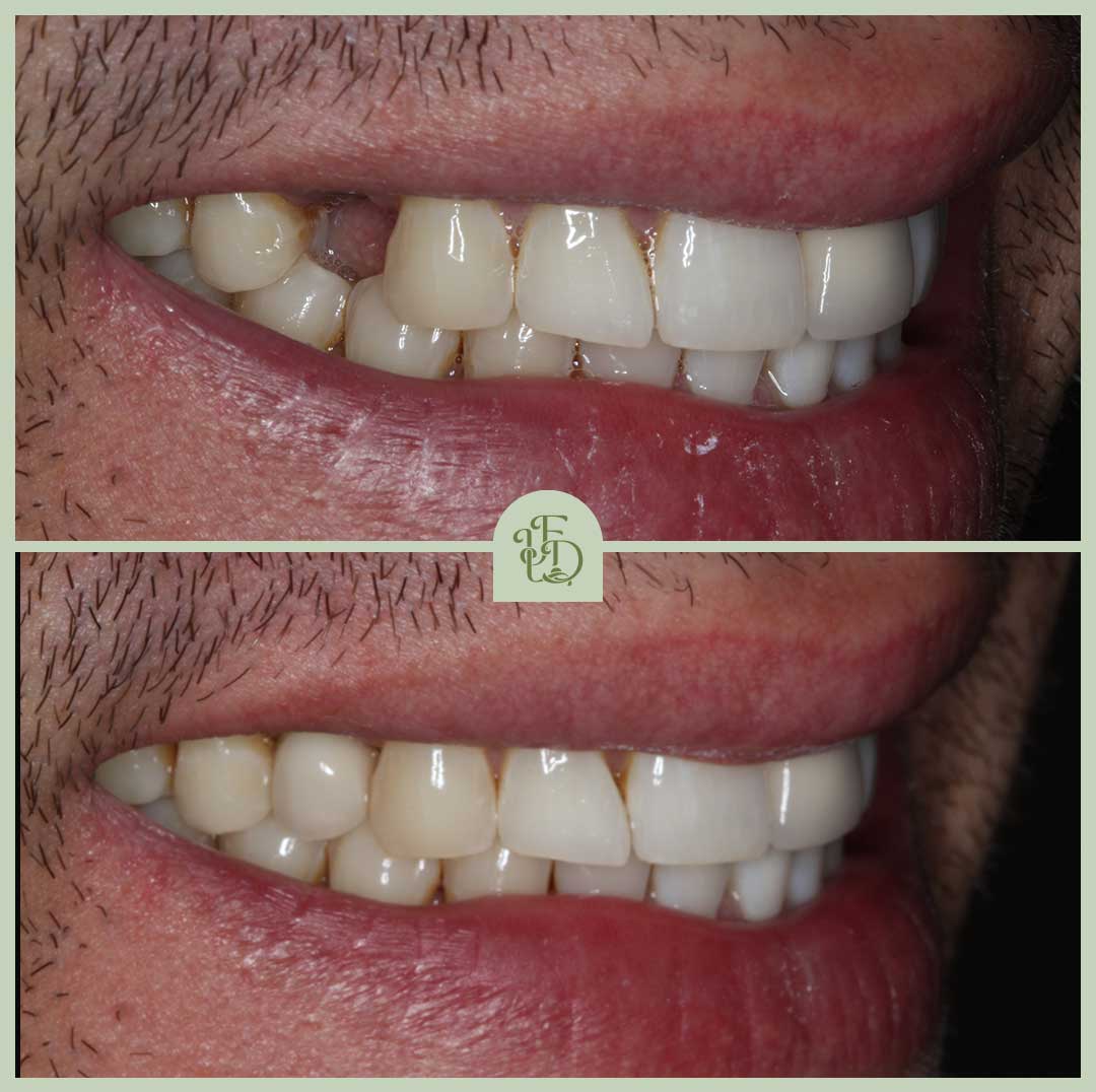 Before and after dental implant in Purley replacing a missing upper tooth, showing a natural-looking implant crown matched to surrounding teeth at Foxley Lane Dental.