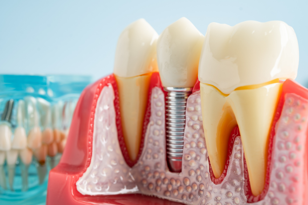 Dental implant model showing a titanium implant replacing a missing tooth root