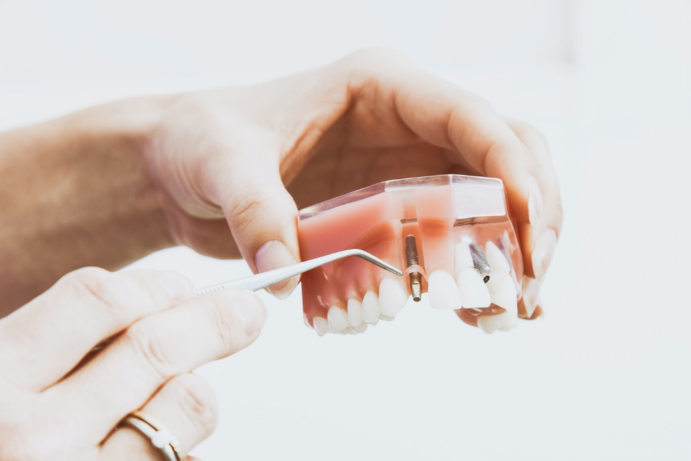 Single tooth dental implant model demonstrating implant-supported crown treatment in Purley