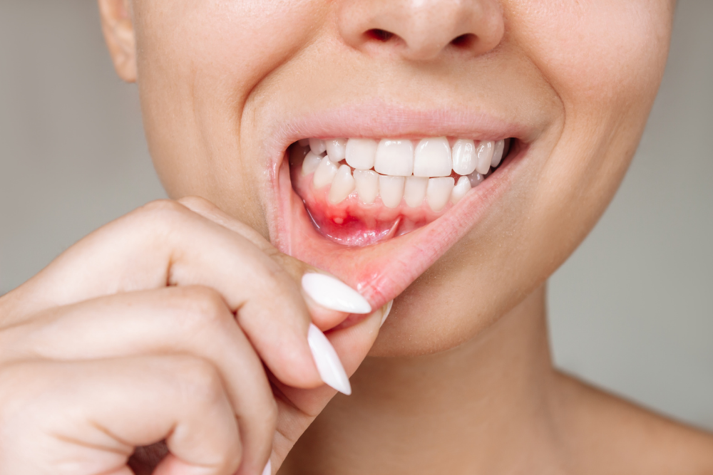 Bleeding gums can be an early sign of gum disease requiring dental hygiene treatment