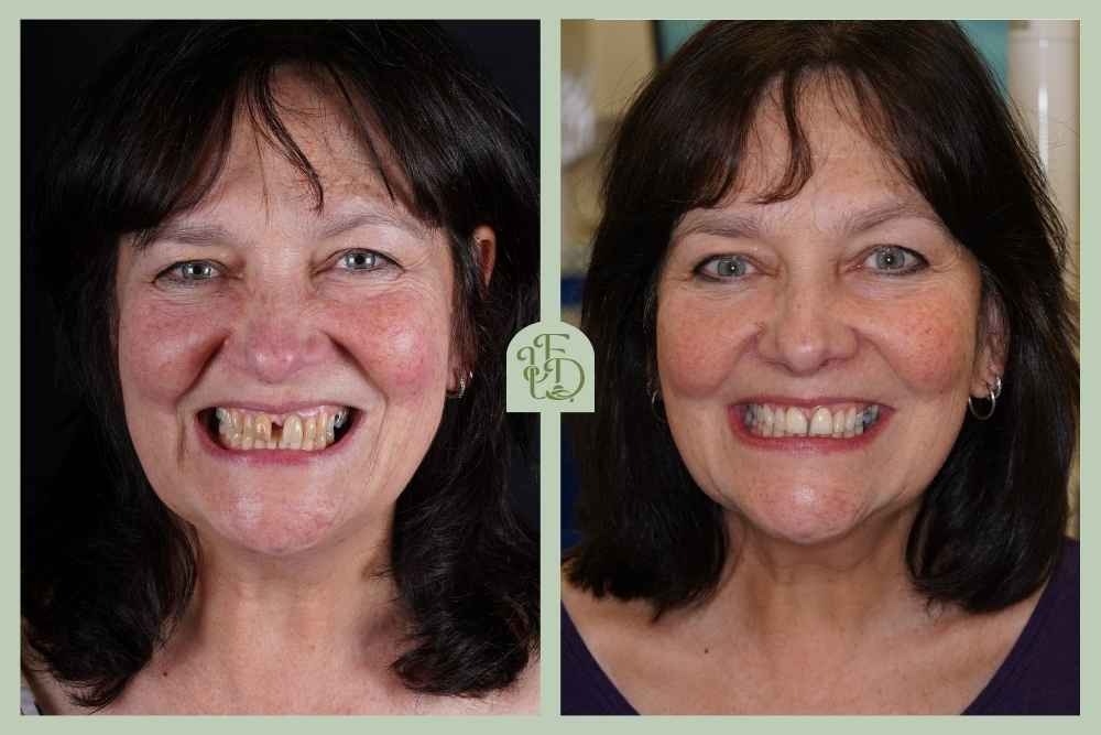 Before and after smile makeover result at Foxley Lane Dental in Purley