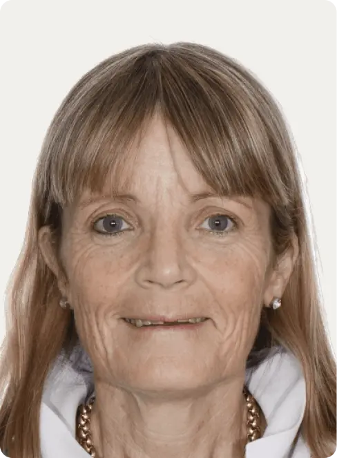 Patient's photo before all-on-4 dental implants treatment at Macquarie Street Dental.