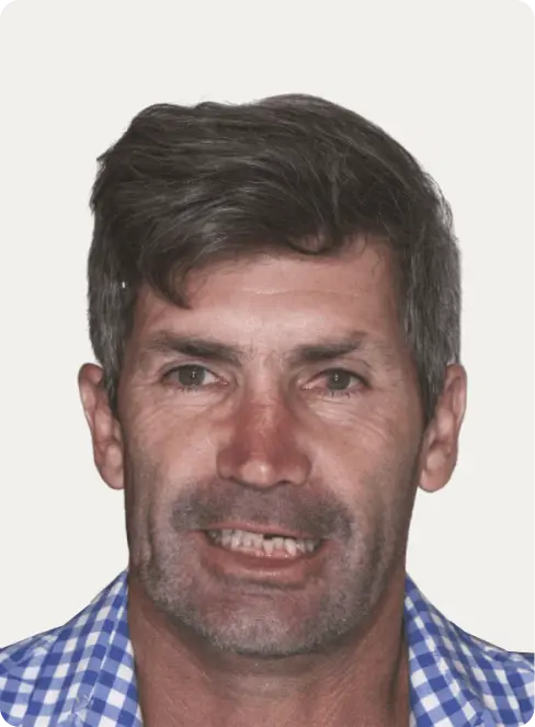 Patient's photo before all-on-4 dental implants treatment at Macquarie Street Dental.