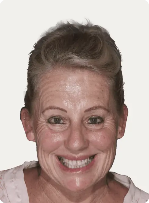 Patient's photo before all-on-4 dental implants treatment at Macquarie Street Dental.