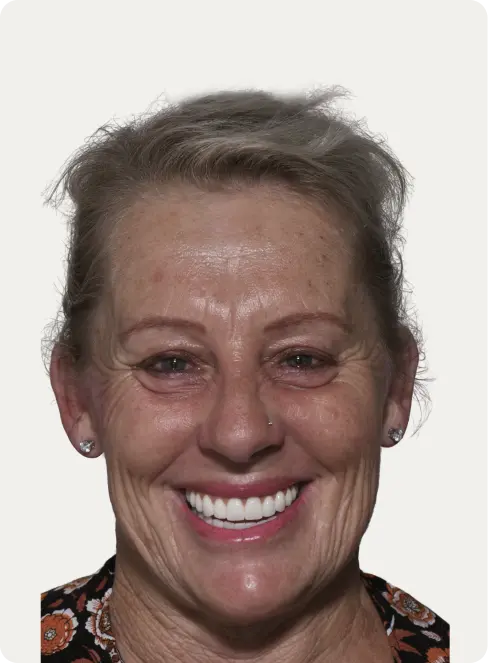 Macquarie Street Dental's patient photo after all-on-4 dental implants treatment.