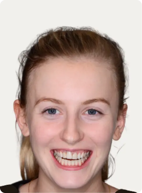 Image of a patient before Dental Implants at Macquarie Street Dental.