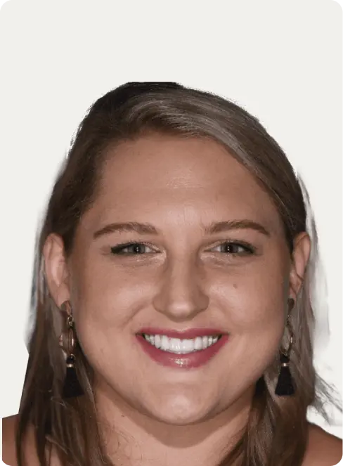 Image of a patient after Dental Implants at Macquarie Street Dental.